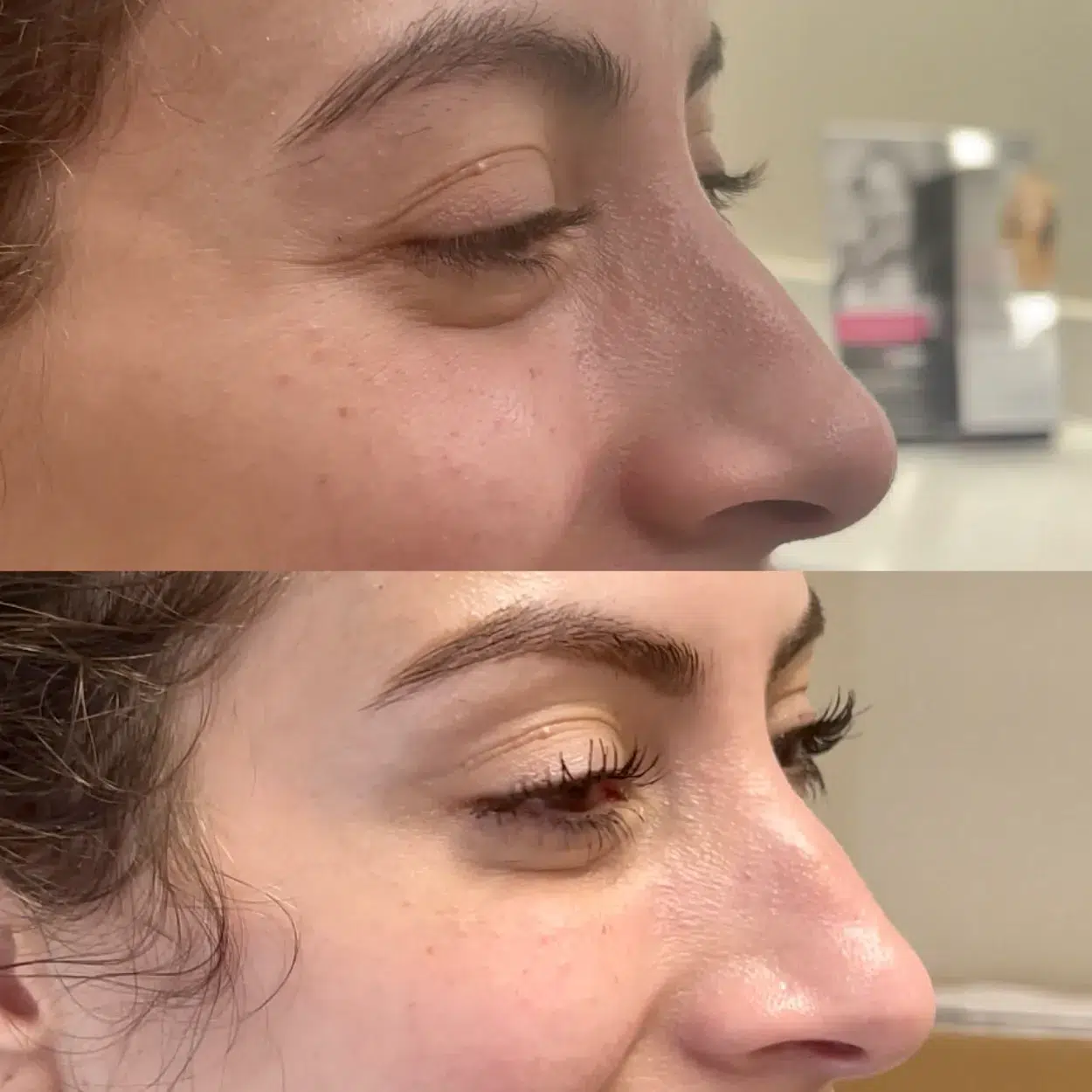 Before and After Image: Eye opening crows feet with Xeomin Neurotoxin - right-front-oblique