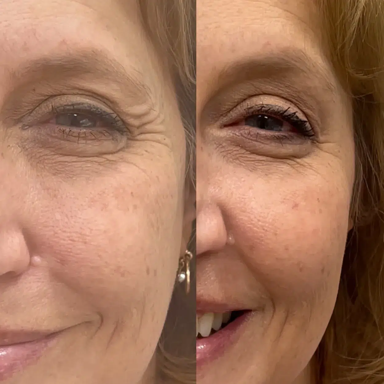 Before and After Image: Eye opening crows feet with Xeomin Neurotoxin - front