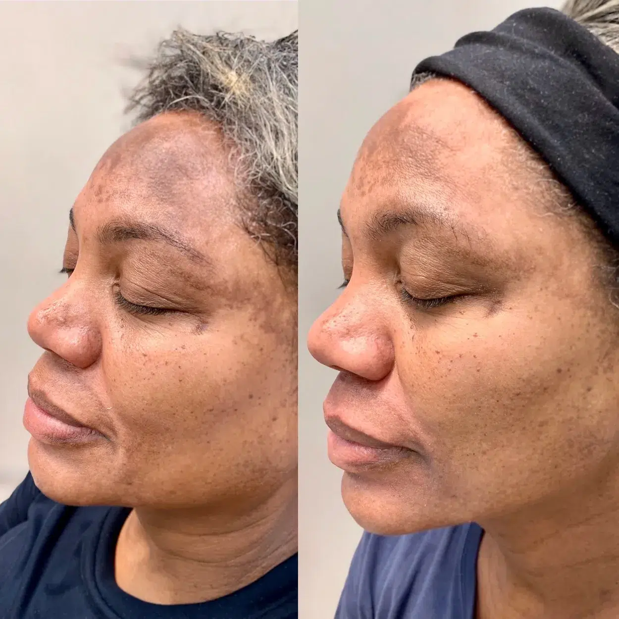 Before and After Image: Eye opening treatment of crows feet with Xeomin Neurotoxin - left-front-oblique