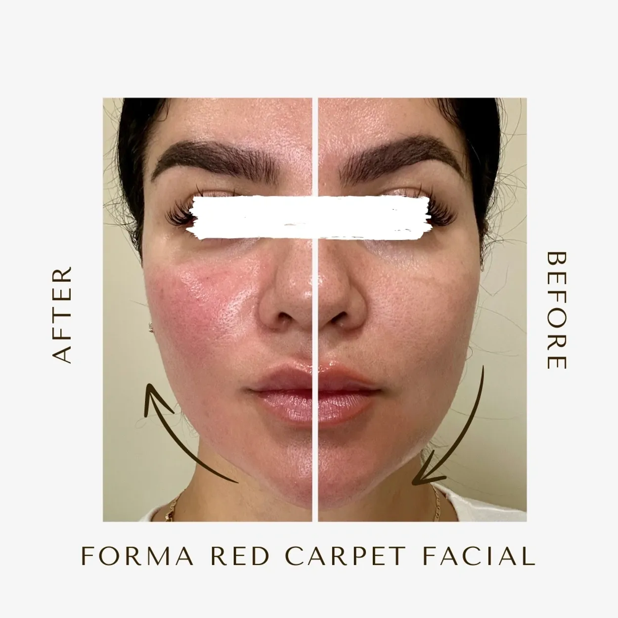 Before and After Image: Forma Red Carpet Facial - front