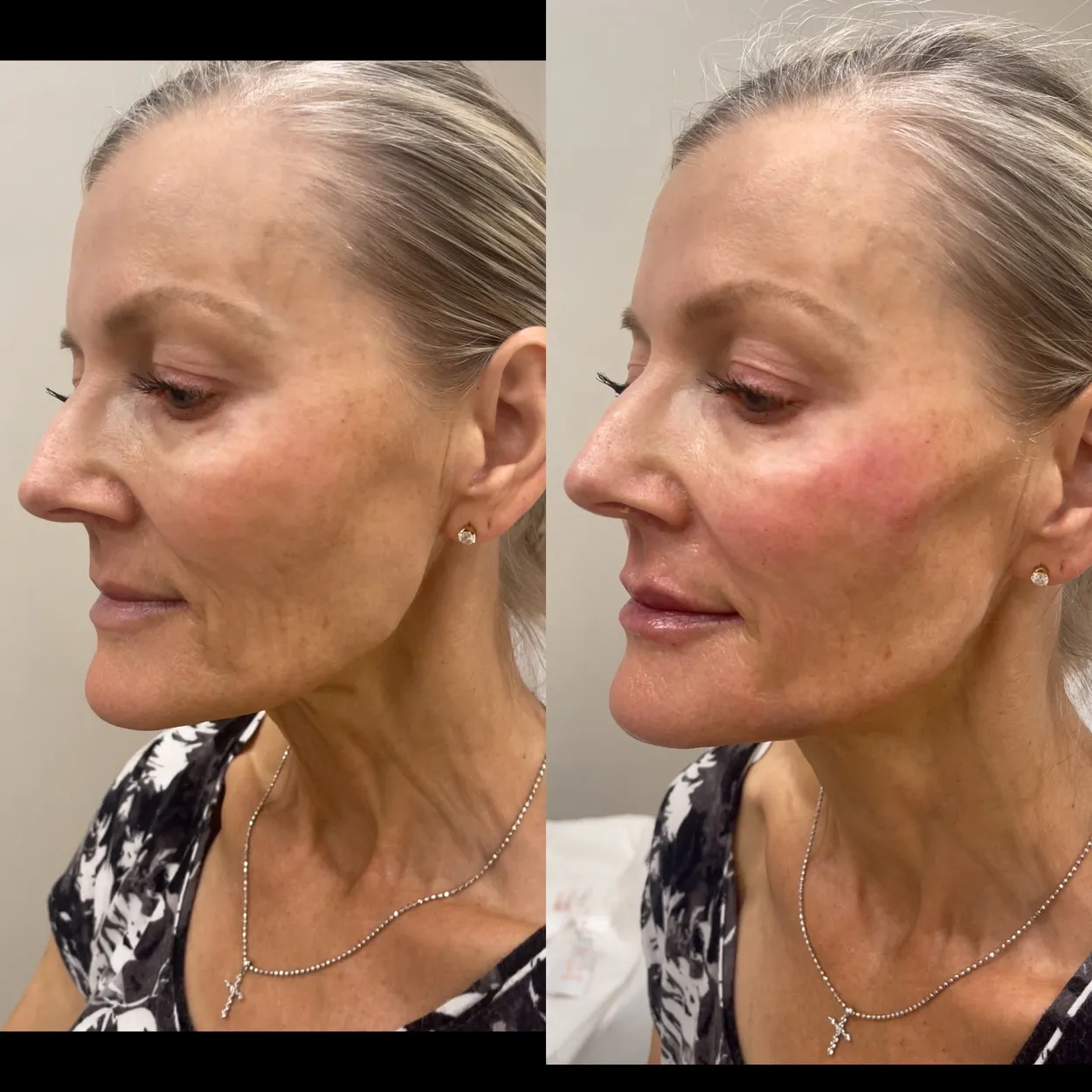 Before and After Image: Full Face Bio stimulation with Radiesse - left-front-oblique