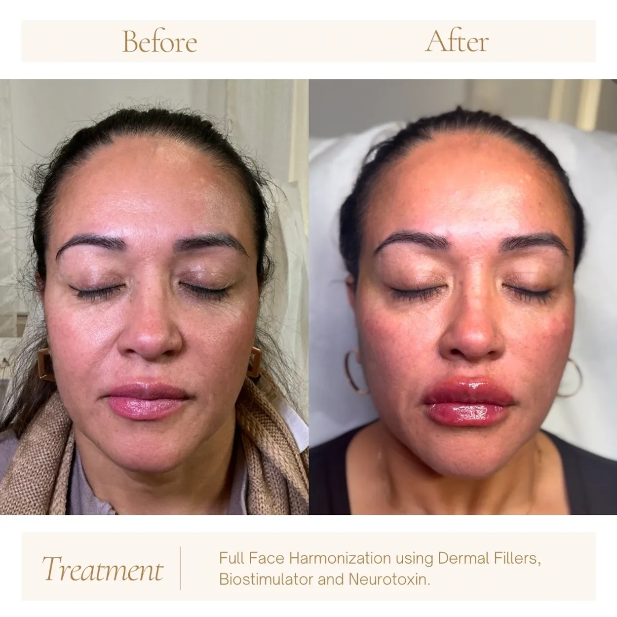 Before and After Image: Full Face Harmonization using Dermal Fillers, Biostimulator and Neurotoxin - front