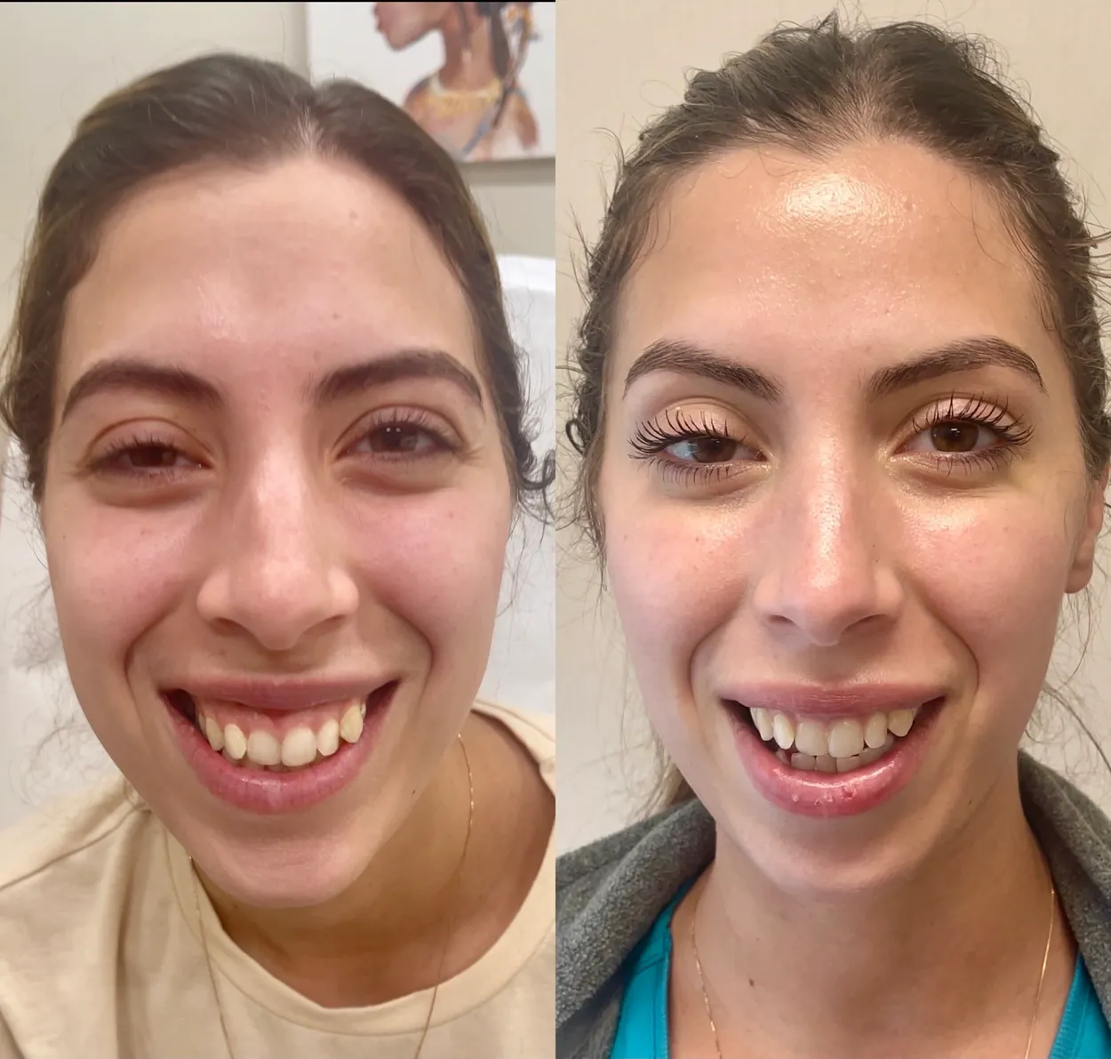 Before and After Image: Full Face Harmonization with dermal fillers and neurotoxin - front