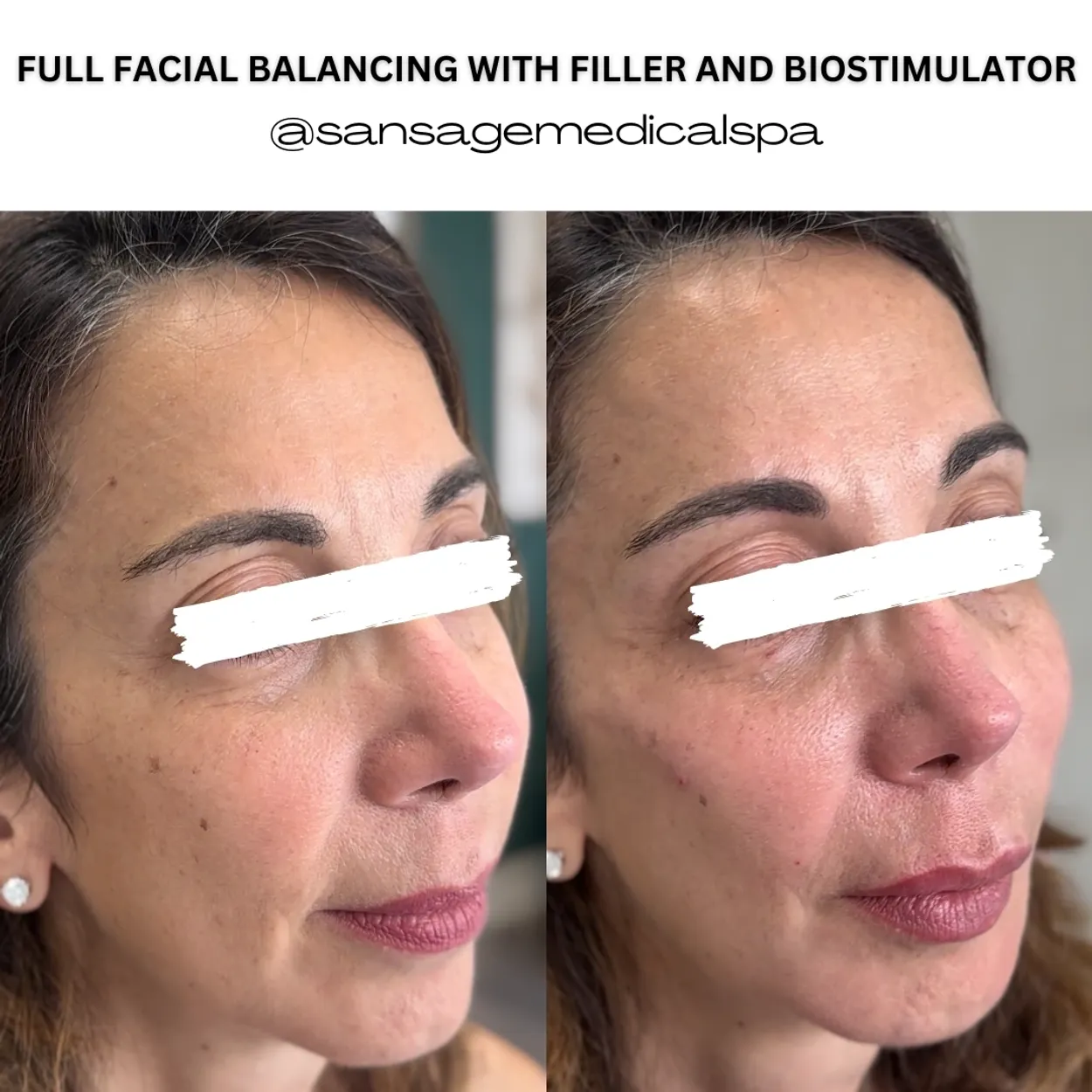 Before and After Image: Full Facial Balancing with Filler and Biostimulator - right-front-oblique