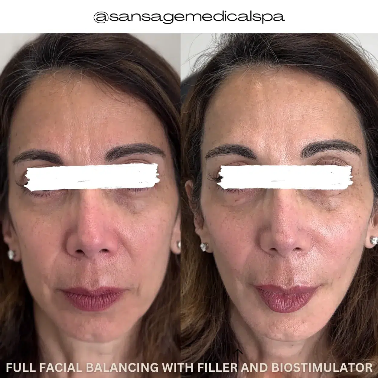 Before and After Image: Full Facial Balancing with Filler and Biostimulator - front