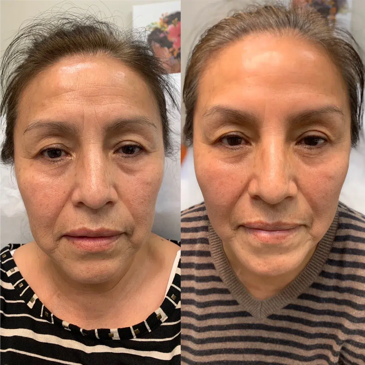 Before and After Image: Full face harmonization with Botox Neurotoxin  - front