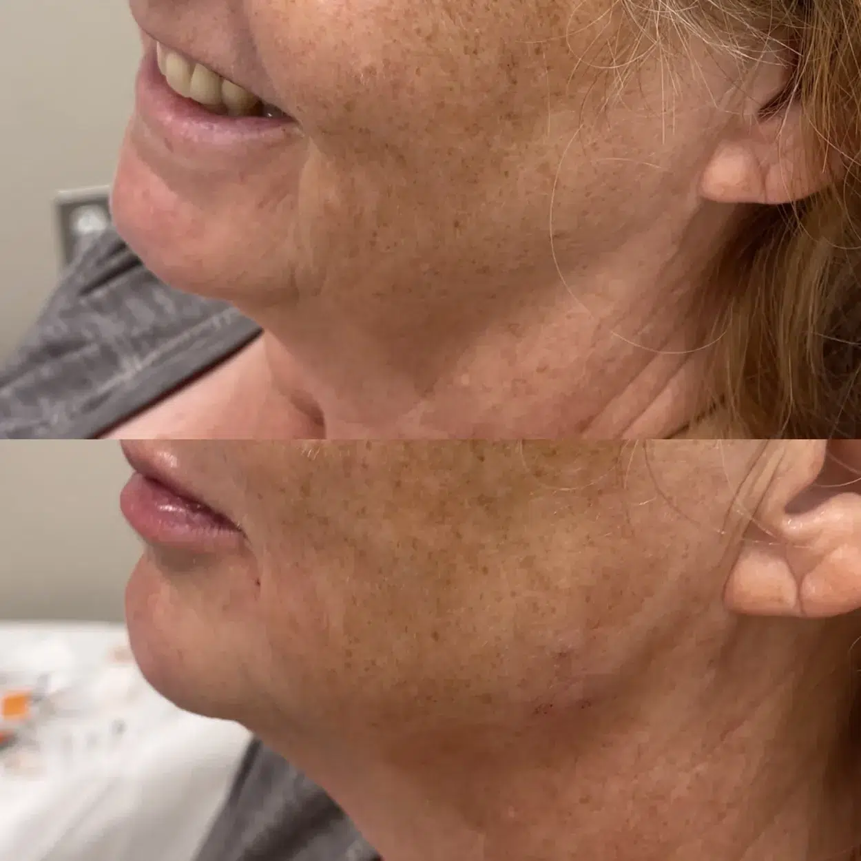 Before and After Image: Jawline enhancement with Radiesse BioStimulator  - front