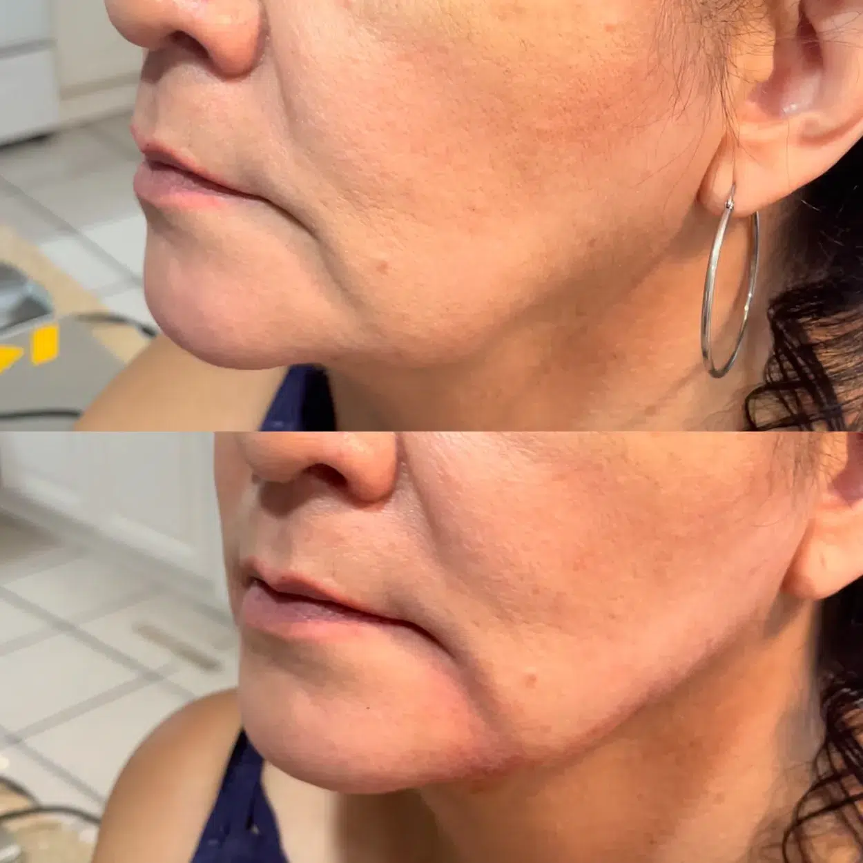 Before and After Image: Jawline enhancement with Radiesse BioStimulator - left-front-oblique