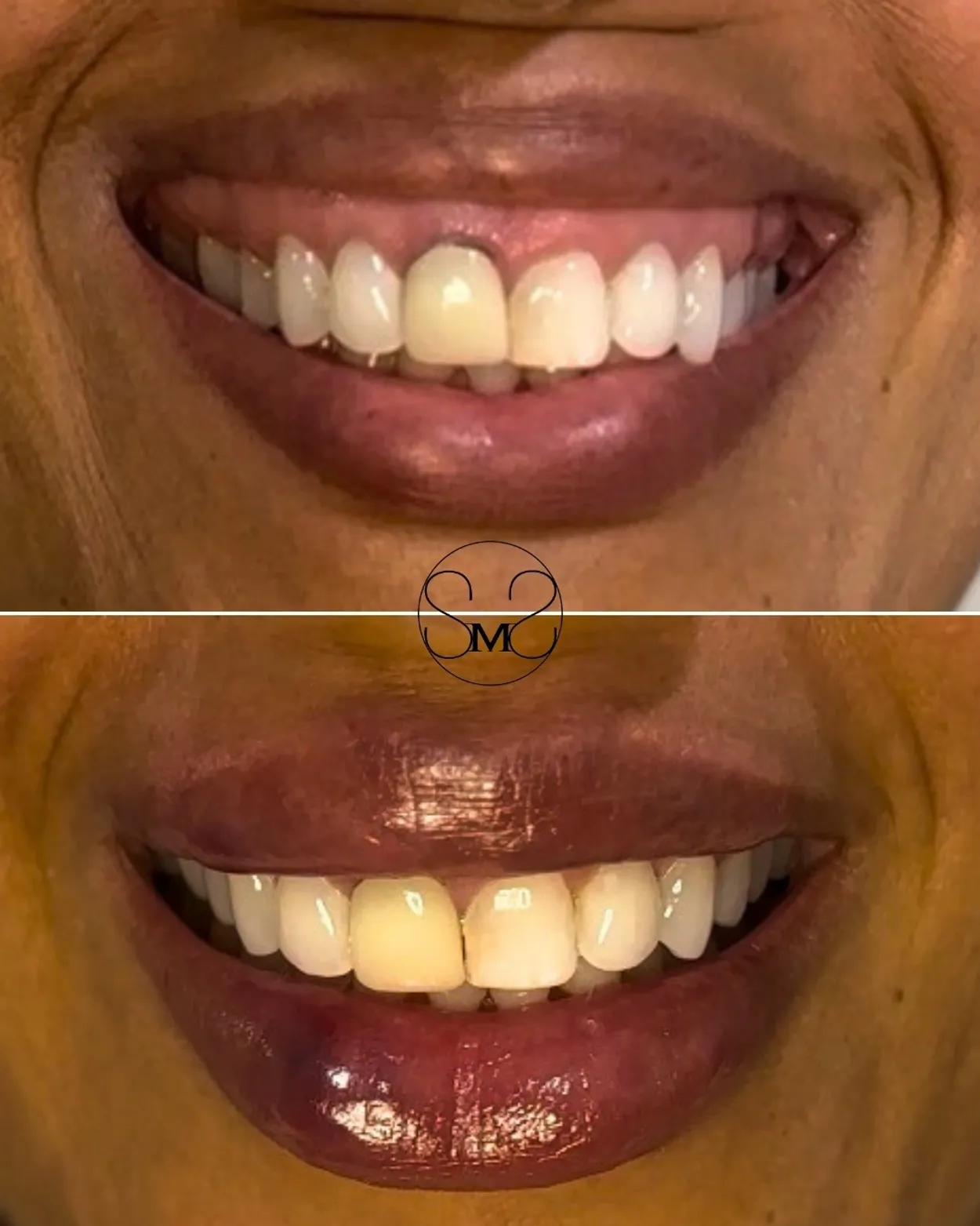 Before and After Image: Lip Filler - front