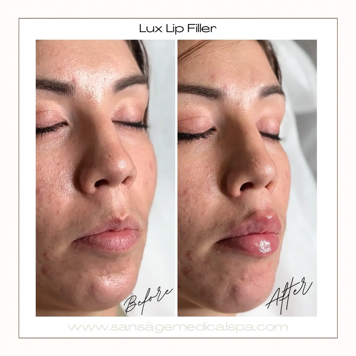 Before and After Image: Lux Lip Filler - right-front-oblique