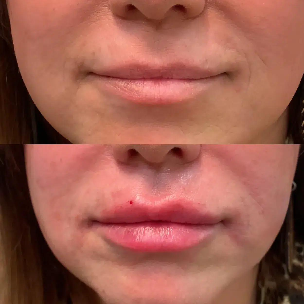 Before and After Image: Lux Lip with Belotero Dermal HA Filler - front