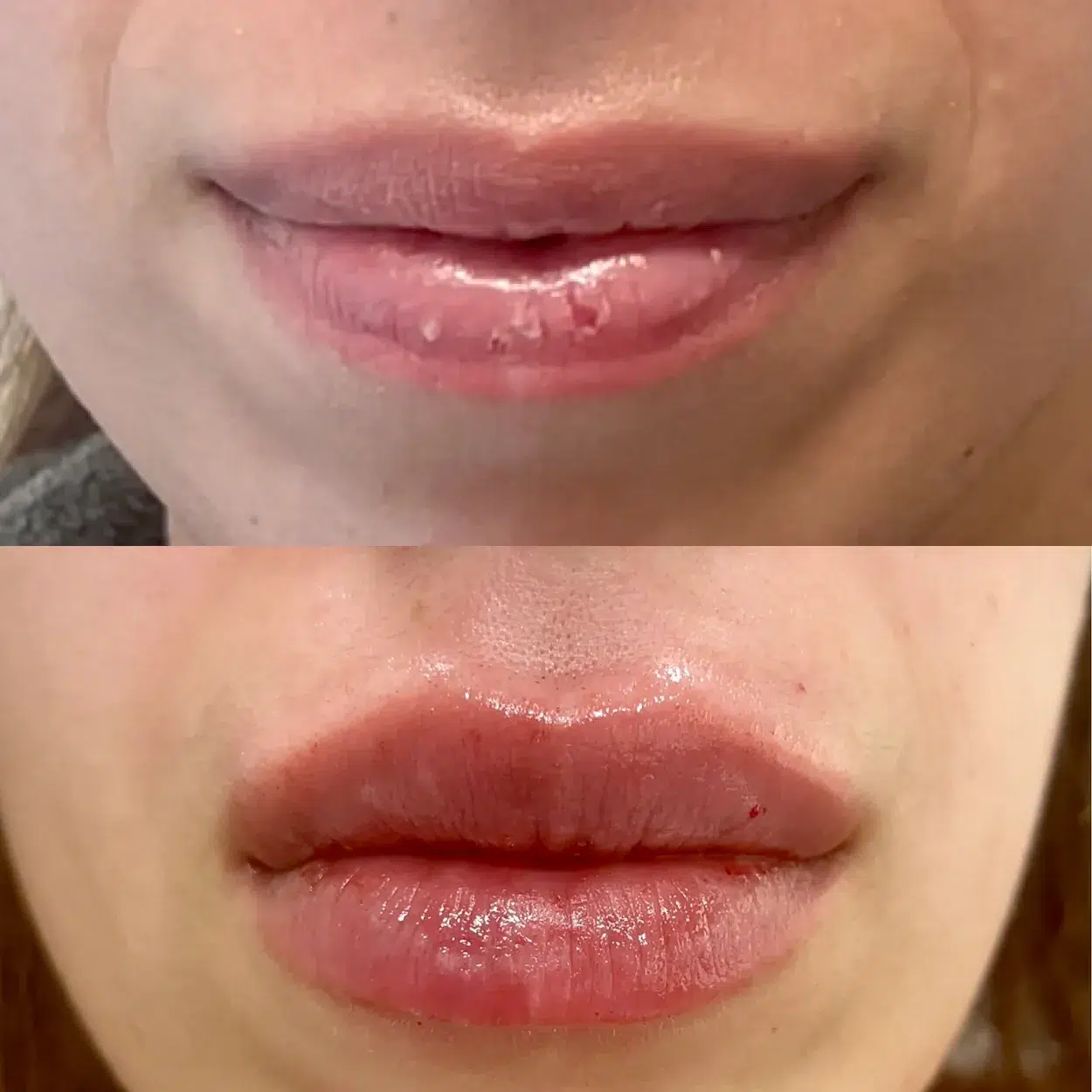 Before and After Image: Lux Lips with Belotero Dermal HA Filler - front