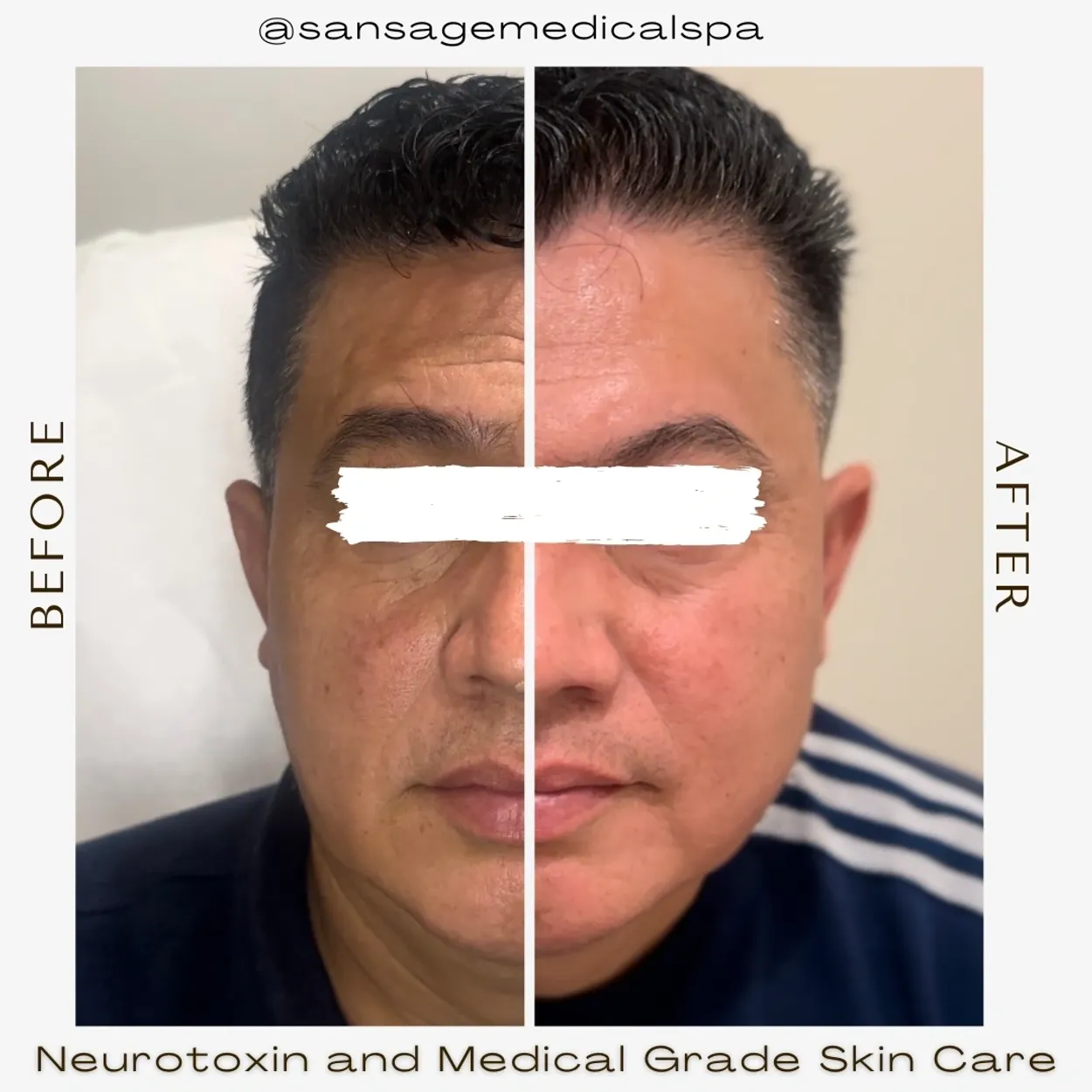 Before and After Image: Neurotoxin and Medical Grade Skin Care - front