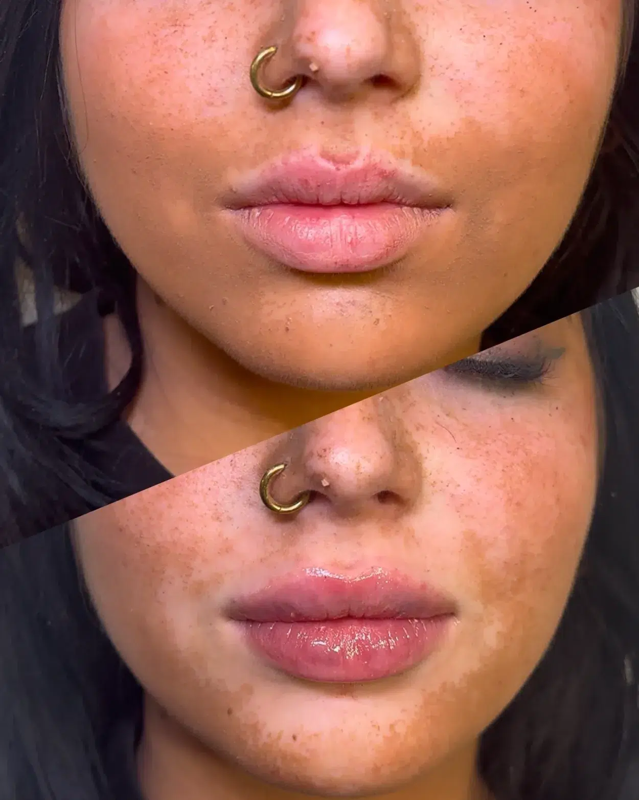 Before and After Image: Lip Filler - front