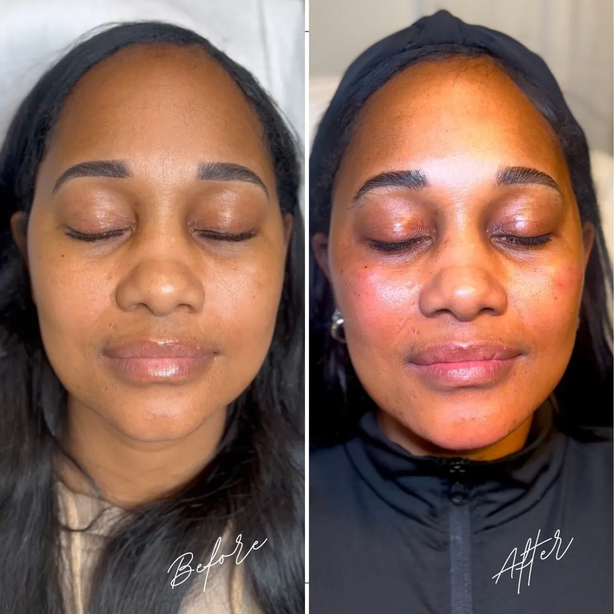 Before and After Image: Lip Filler - front
