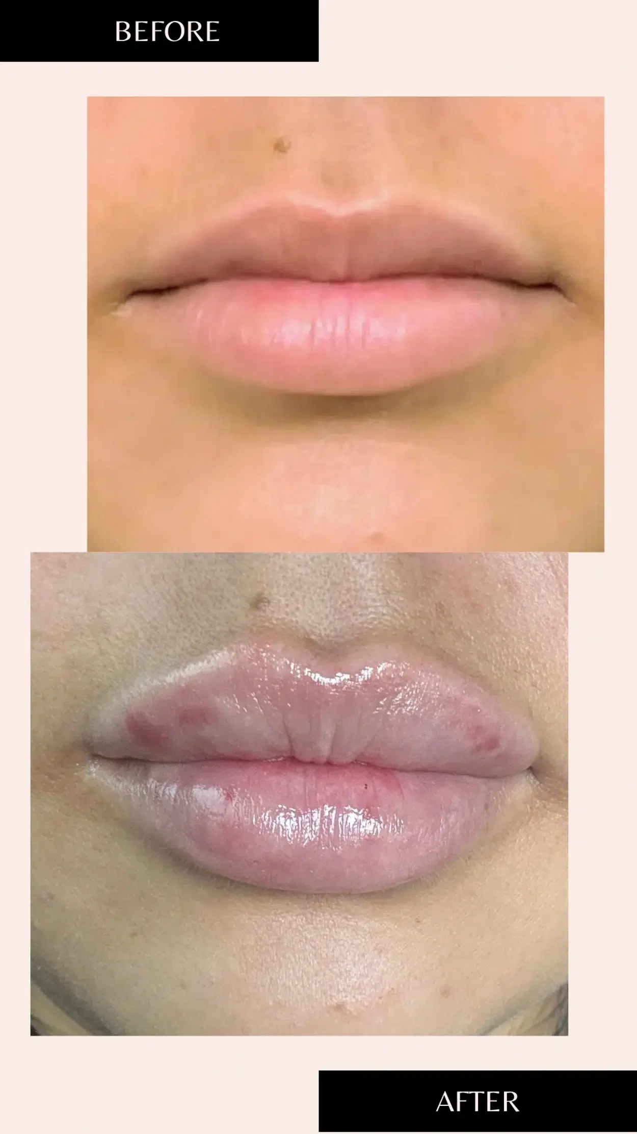 Before and After Image: Lip Filler - front