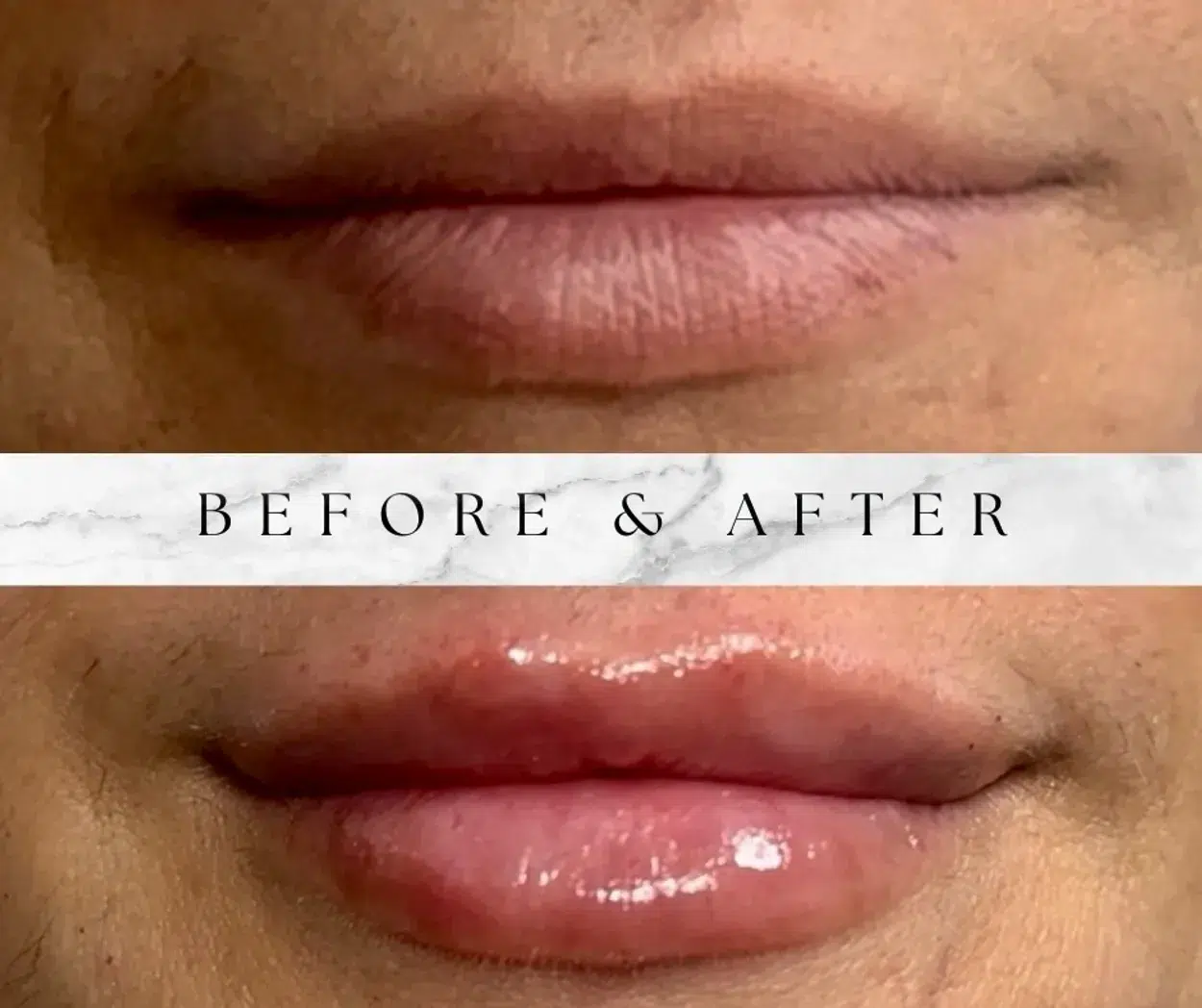 Before and After Image: Lip Filler - front