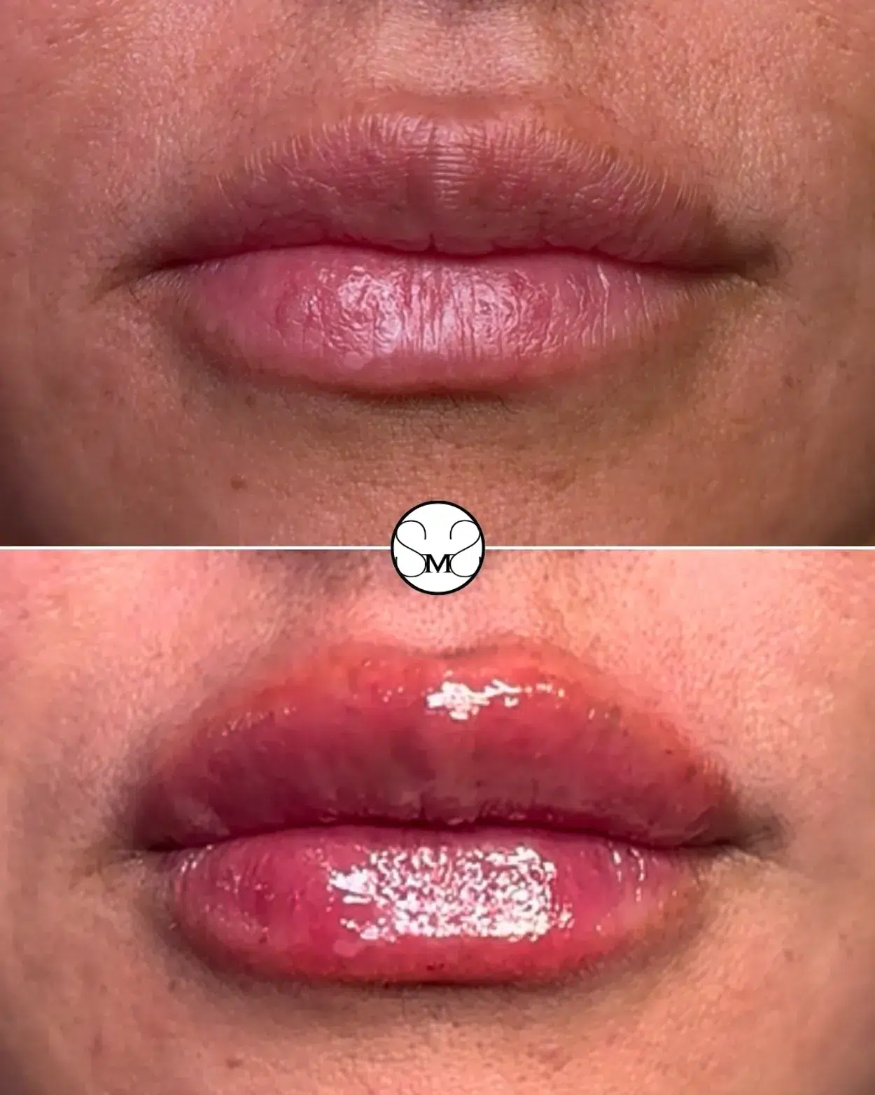 Before and After Image: Lip Filler - front