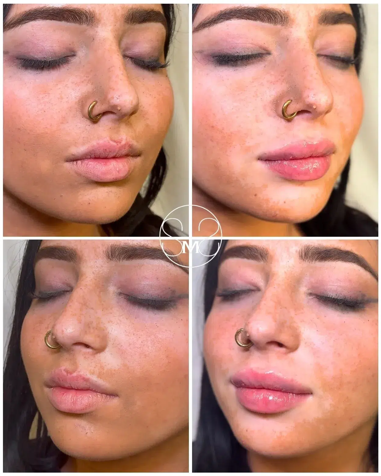 Before and After Image: Lip Filler - front