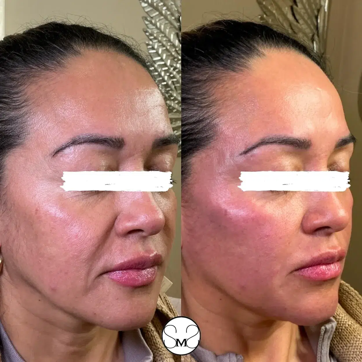Before and After Image: lip Filler - right-front-oblique