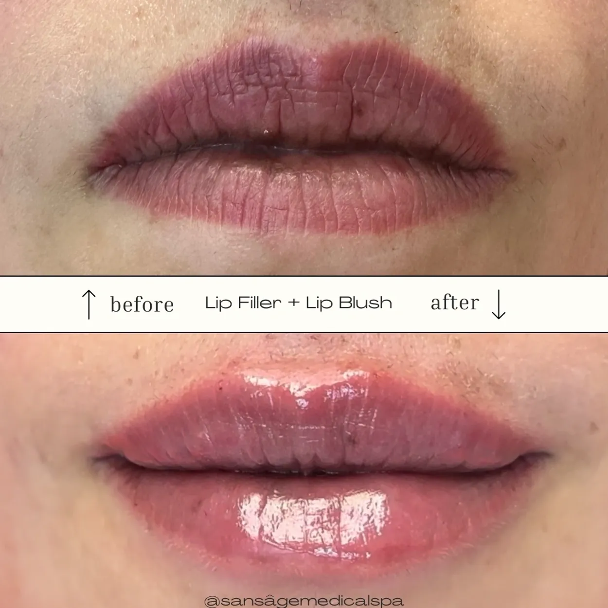 Before and After Image: Lip Filler + Lip Blush - front