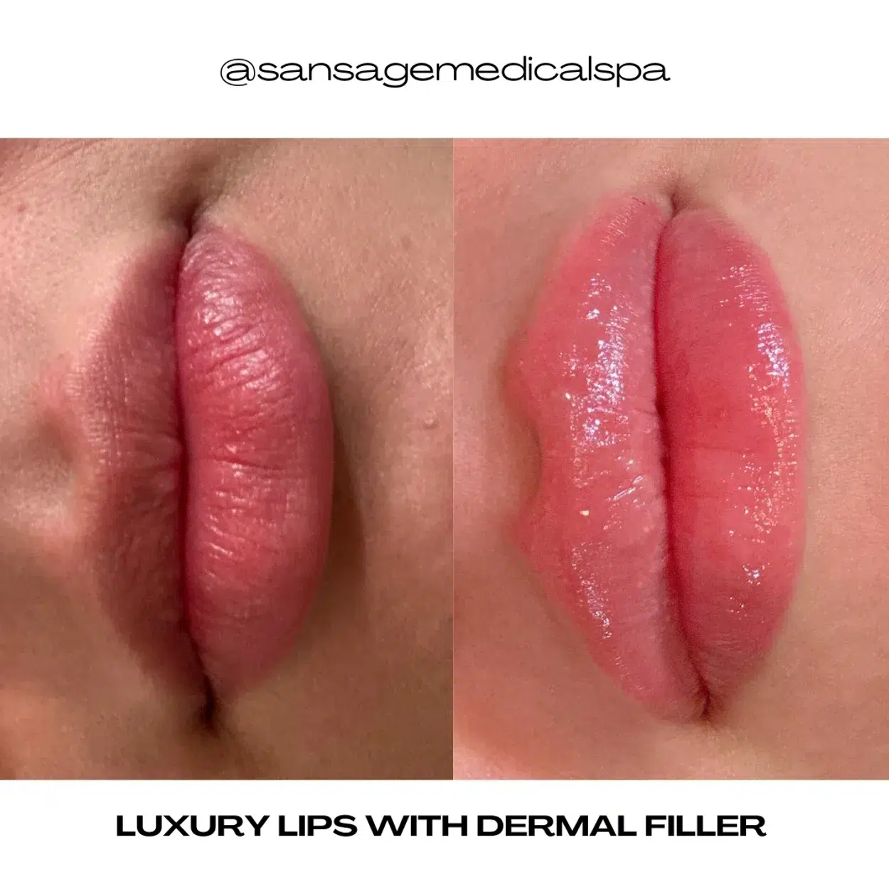 Before and After Image: Luxury Lips + Dermal Filler - front