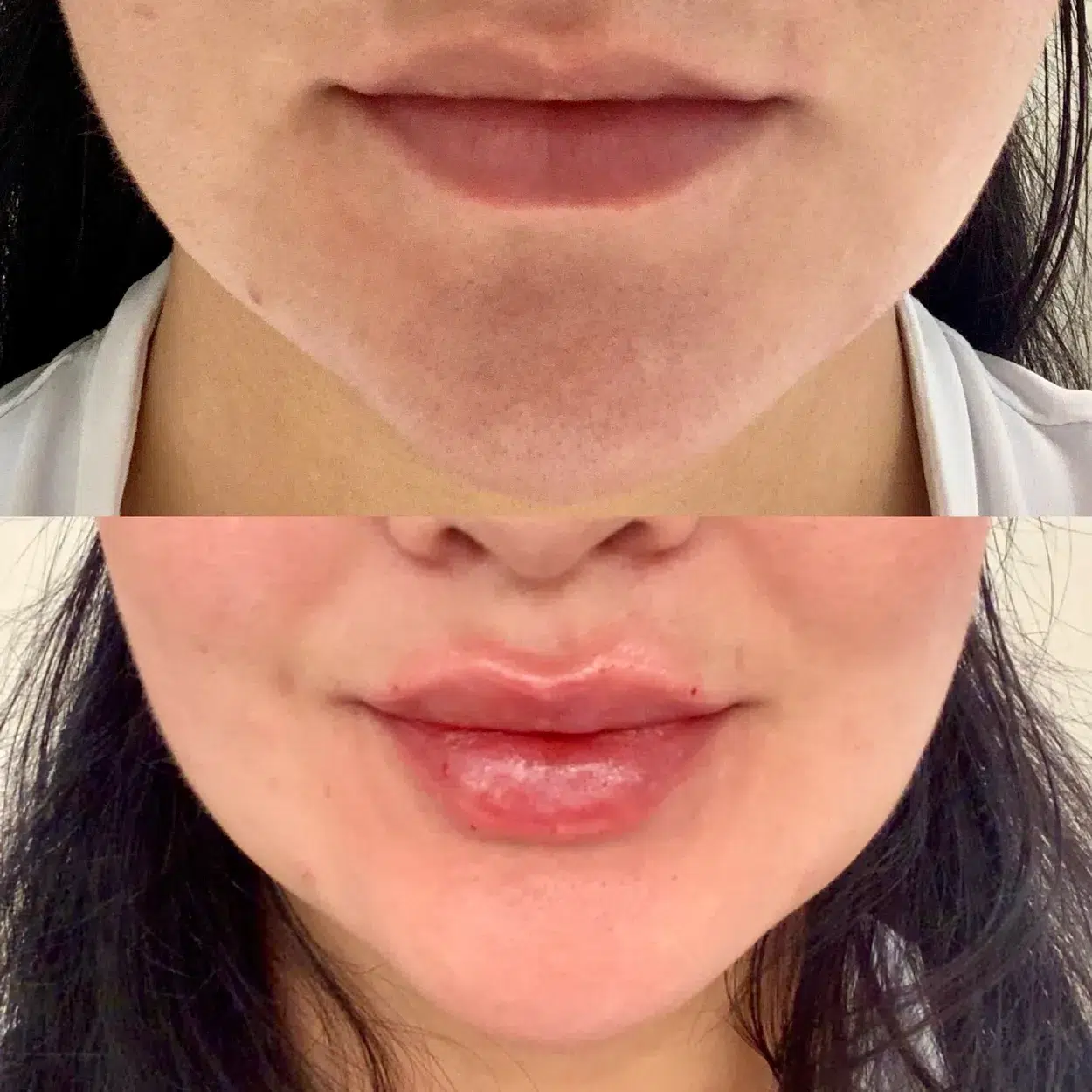 Before and After Image: Lux Lip with Belotero Dermal Filler  - front