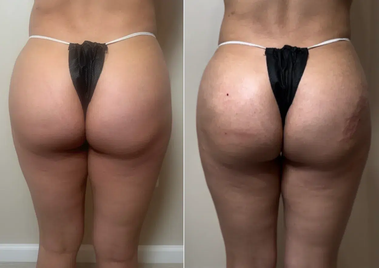 Before and After Image: Instant/Liquid BBL with 6 syringes of Radiesse BioStimulator  - back